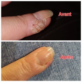 Verrues avant et après Verrues doigts avant et après séance de magnétisme