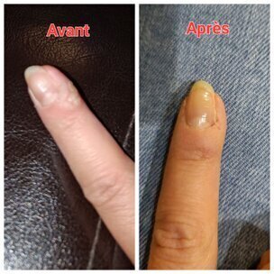 Verrues sur doigts, avant et après séance de magnétisme