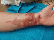 Brulure après séance Brûlure avant bras après séance