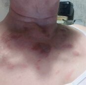 Brûlure avant séance